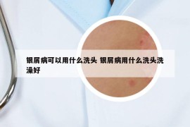 银屑病可以用什么洗头 银屑病用什么洗头洗澡好