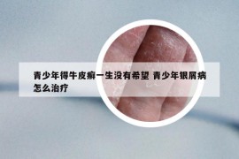 青少年得牛皮癣一生没有希望 青少年银屑病怎么治疗