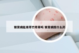 银霄病能用萃竹奇草吗 银霄病擦什么药