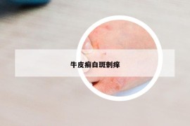 牛皮癣白斑刺痒