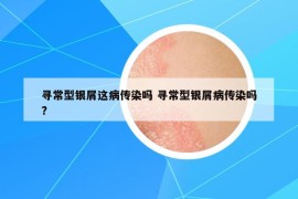 寻常型银屑这病传染吗 寻常型银屑病传染吗?