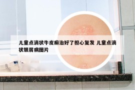 儿童点滴状牛皮癣治好了担心复发 儿童点滴状银屑病图片