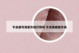 牛皮癣可用紫外线灯照吗 牛皮肤癣紫外线