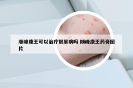 顺峰康王可以治疗银屑病吗 顺峰康王药膏图片