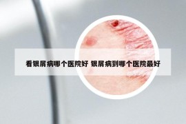 看银屑病哪个医院好 银屑病到哪个医院最好