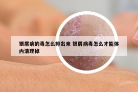 银屑病的毒怎么排出来 银屑病毒怎么才能体内清理掉