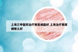 上海三甲医院治疗银屑病最好 上海治疗银屑病哪儿好