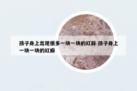 孩子身上出现很多一块一块的红藓 孩子身上一块一块的红癣