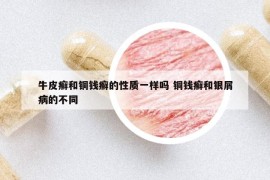牛皮癣和铜钱癣的性质一样吗 铜钱癣和银屑病的不同