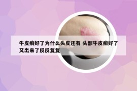牛皮癣好了为什么头皮还有 头部牛皮癣好了又出来了反反复复