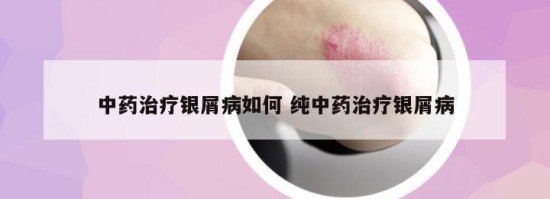 中药治疗银屑病如何 纯中药治疗银屑病