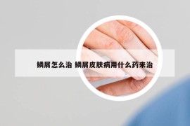 鳞屑怎么治 鳞屑皮肤病用什么药来治
