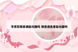 寻常型银屑病能吃醋吗 银屑病患者能吃醋吗