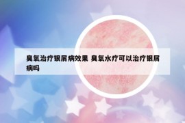 臭氧治疗银屑病效果 臭氧水疗可以治疗银屑病吗