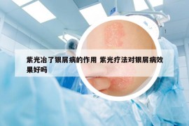 紫光冶了银屑病的作用 紫光疗法对银屑病效果好吗