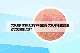 大庆最好的皮肤病专科医院 大庆哪家医院治疗皮肤病比较好