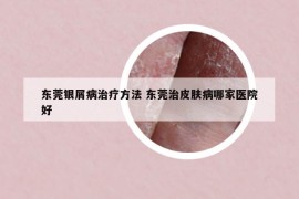 东莞银屑病治疗方法 东莞治皮肤病哪家医院好