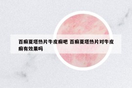 百癣夏塔热片牛皮癣吧 百癣夏塔热片对牛皮癣有效果吗