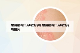 银屑病有什么特效药啊 银屑病有什么特效药啊图片