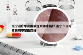 南宁治疗牛皮癣病医院哪家最好 南宁市治疗皮肤病哪家医院好