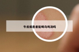 牛皮癣患者能喝乌鸡汤吗