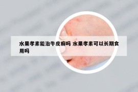 水果孝素能治牛皮癣吗 水果孝素可以长期食用吗