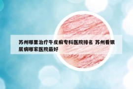 苏州哪里治疗牛皮癣专科医院排名 苏州看银屑病哪家医院最好