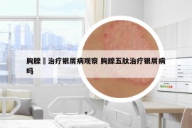 胸腺舦治疗银屑病观察 胸腺五肽治疗银屑病吗