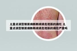 儿童点滴型银屑病断断续续出现新的病灶 儿童点滴型银屑病断断续续出现新的病灶严重吗