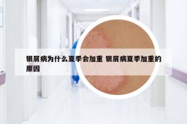 银屑病为什么夏季会加重 银屑病夏季加重的原因
