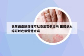 银屑病皮肤瘙痒可以吃氯雷他定吗 银屑病太痒可以吃氯雷他定吗