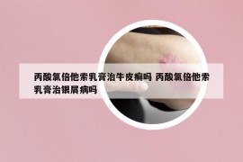丙酸氯倍他索乳膏治牛皮癣吗 丙酸氯倍他索乳膏治银屑病吗