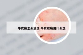牛皮癣怎么清洗 牛皮肤癣用什么洗