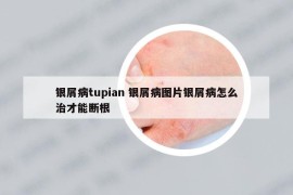 银屑病tupian 银屑病图片银屑病怎么治才能断根