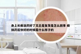 身上长癣涂药好了又总是复发是怎么回事 癣抹药后快好的时候是什么样子的
