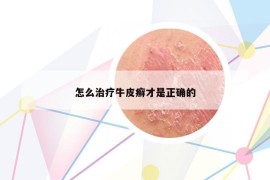 怎么治疗牛皮癣才是正确的