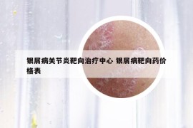 银屑病关节炎靶向治疗中心 银屑病靶向药价格表