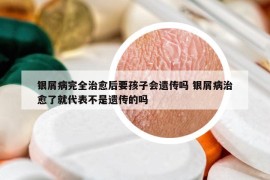银屑病完全治愈后要孩子会遗传吗 银屑病治愈了就代表不是遗传的吗