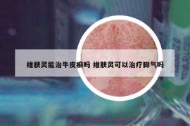维肤灵能治牛皮癣吗 维肤灵可以治疗脚气吗