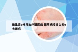 维生素e外用治疗银屑病 银屑病擦维生素e有用吗