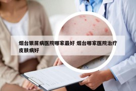 烟台银屑病医院哪家最好 烟台哪家医院治疗皮肤病好