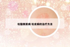 松脂银屑病 松皮癣的治疗方法