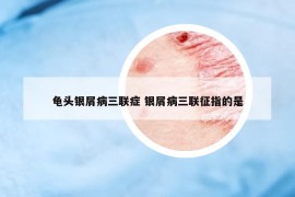 龟头银屑病三联症 银屑病三联征指的是