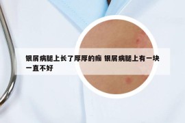 银屑病腿上长了厚厚的痂 银屑病腿上有一块一直不好