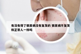 有没有得了银屑病没有复发的 银屑病不复发和正常人一样吗