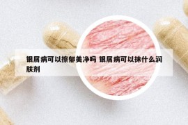 银屑病可以擦郁美净吗 银屑病可以抹什么润肤剂
