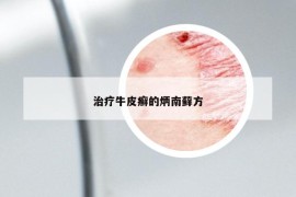 治疗牛皮癣的炳南藓方