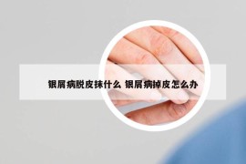 银屑病脱皮抹什么 银屑病掉皮怎么办