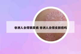 非洲人会得银屑病 非洲人会得皮肤癌吗
