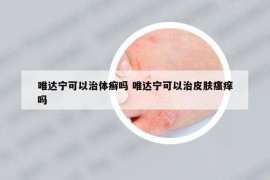 唯达宁可以治体癣吗 唯达宁可以治皮肤瘙痒吗